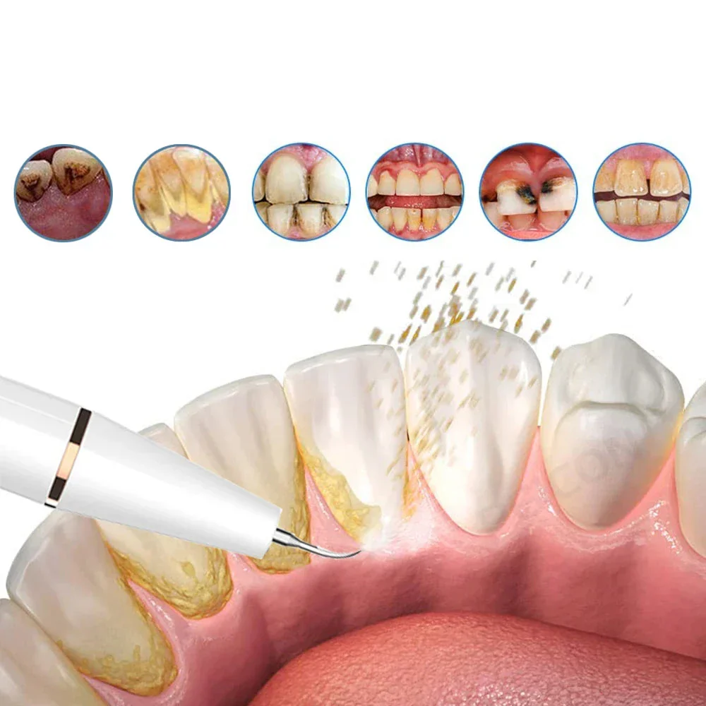 Ultrasonic Scaler | Stain-Removing Dental Tool for Home - Image 9